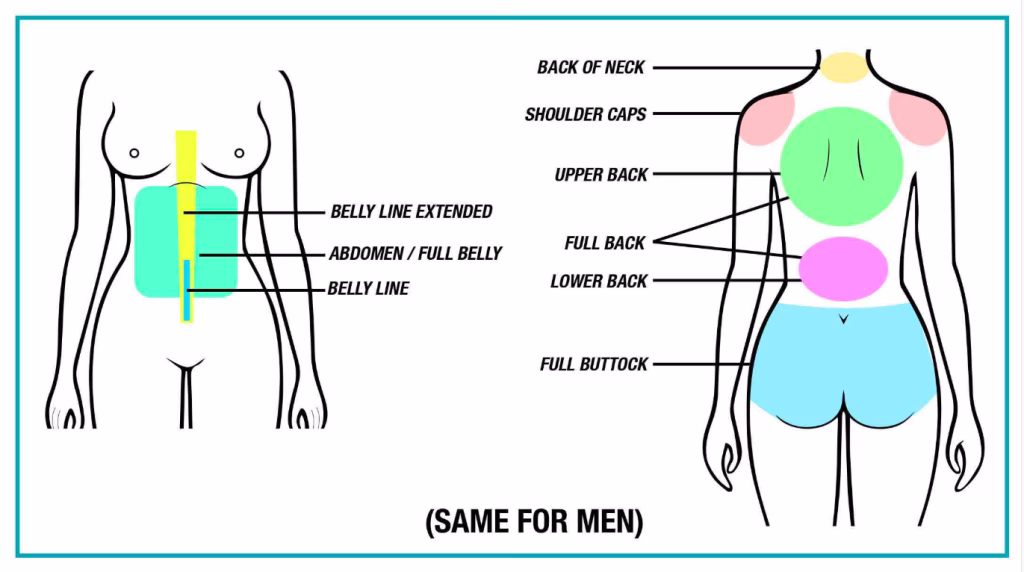 Laser Treatment Areas on Body