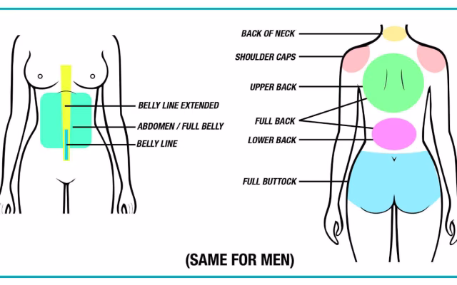 Laser Treatment Areas on Body