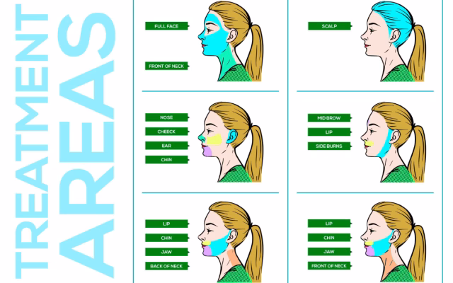 Laser Treatment Areas on Face