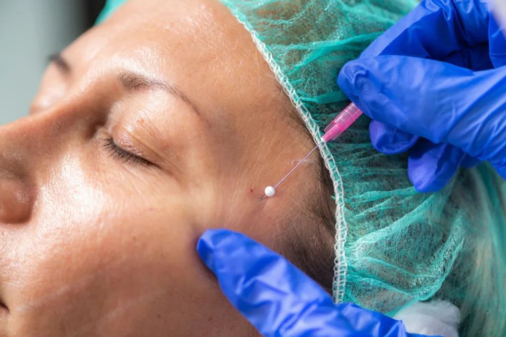 cheek thread lift